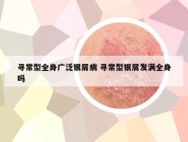 寻常型全身广泛银屑病 寻常型银屑发满全身吗