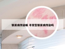 银屑病传染嘛 寻常型银屑病传染吗