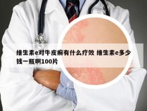 维生素e对牛皮癣有什么疗效 维生素e多少钱一瓶啊100片