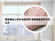 银屑病女人怀孕会复发吗 银屑病患者怀孕怎么办