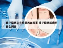 孩子胳膊上有癣是怎么回事 孩子胳膊起癣用什么药膏