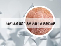 头部牛皮廨图片牛皮廨 头部牛皮肤癣的症状