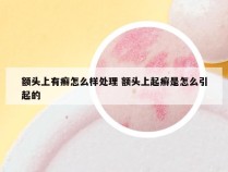 额头上有癣怎么样处理 额头上起癣是怎么引起的