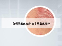 白咧风怎么治疗 白瘨风怎么治疗