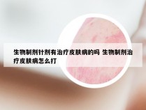 生物制剂针剂有治疗皮肤病的吗 生物制剂治疗皮肤病怎么打