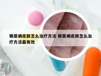 银屑病皮肤怎么治疗方法 银屑病皮肤怎么治疗方法最有效