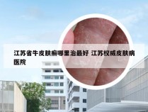 江苏省牛皮肤癣哪里治最好 江苏权威皮肤病医院