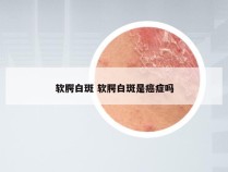 软腭白斑 软腭白斑是癌症吗