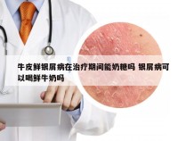 牛皮鲜银屑病在治疗期间能奶糖吗 银屑病可以喝鲜牛奶吗