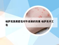 哈萨克族黑肥皂对牛皮癣的效果 哈萨克手工皂