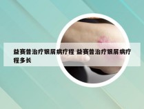 益赛普治疗银屑病疗程 益赛普治疗银屑病疗程多长