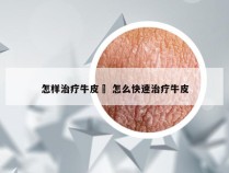 怎样治疗牛皮廯 怎么快速治疗牛皮