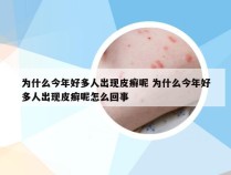 为什么今年好多人出现皮癣呢 为什么今年好多人出现皮癣呢怎么回事