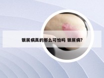 银屑病真的那么可怕吗 银屑病?