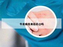 牛皮癣出来后忌口吗