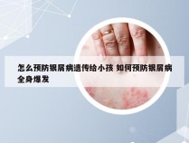 怎么预防银屑病遗传给小孩 如何预防银屑病全身爆发