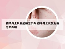 孩子身上反复起癣怎么办 孩子身上反复起癣怎么办啊