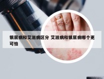 银屑病和艾滋病区分 艾滋病和银屑病哪个更可怕