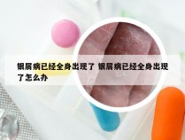 银屑病已经全身出现了 银屑病已经全身出现了怎么办