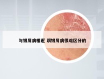 与银屑病相近 跟银屑病很难区分的