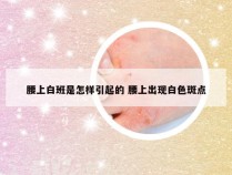 腰上白班是怎样引起的 腰上出现白色斑点