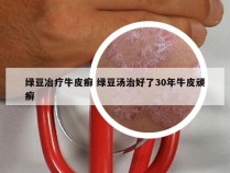 绿豆冶疗牛皮癣 绿豆汤治好了30年牛皮顽癣