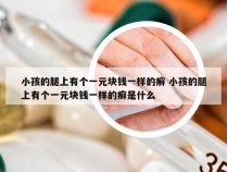 小孩的腿上有个一元块钱一样的癣 小孩的腿上有个一元块钱一样的癣是什么