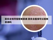 新农合如何报销银屑病 新农合医保可以报银屑病吗