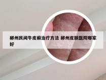 郴州民间牛皮癣治疗方法 郴州皮肤医院哪家好