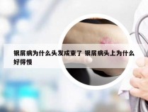 银屑病为什么头发成束了 银屑病头上为什么好得慢