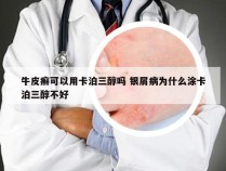 牛皮癣可以用卡泊三醇吗 银屑病为什么涂卡泊三醇不好