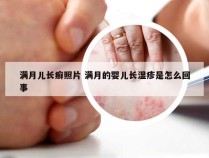 满月儿长癣照片 满月的婴儿长湿疹是怎么回事