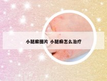 小腿廨图片 小腿癣怎么治疗