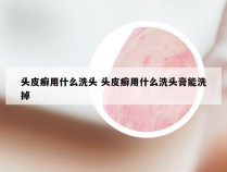 头皮癣用什么洗头 头皮癣用什么洗头膏能洗掉