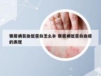 银屑病贫血低蛋白怎么补 银屑病低蛋白血症的表现