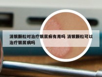 消银颗粒对治疗银屑癣有用吗 消银颗粒可以治疗银屑病吗