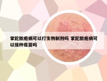 掌跎脓疱病可以打生物制剂吗 掌跎脓疱病可以接种疫苗吗