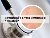 红皮病银屑病最佳治疗方法 红皮病型银屑病外用药治疗首选