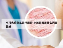 小孩头癣怎么治疗最好 小孩头癣用什么药膏最好