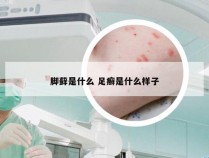 脚藓是什么 足癣是什么样子