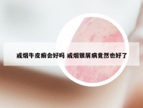 戒烟牛皮癣会好吗 戒烟银屑病竟然也好了