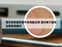 重庆哪家医院看牛皮癣最正规 重庆哪个医生治银屑病最好