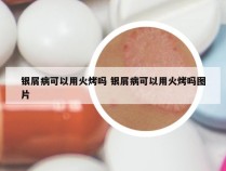 银屑病可以用火烤吗 银屑病可以用火烤吗图片