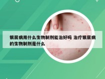 银屑病用什么生物制剂能治好吗 治疗银屑病的生物制剂是什么