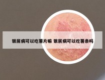 银屑病可以吃薯片嘛 银屑病可以吃薯条吗