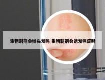 生物制剂会掉头发吗 生物制剂会诱发癌症吗