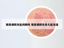 银屑病照光能间断吗 银屑病照光多久能洗澡