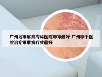 广州治银屑病专科医院哪家最好 广州哪个医院治疗银屑病疗效最好