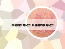 银屑病公开秘方 银屑病的偏方秘方