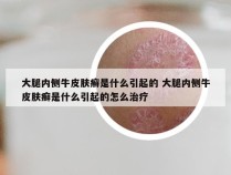 大腿内侧牛皮肤癣是什么引起的 大腿内侧牛皮肤癣是什么引起的怎么治疗